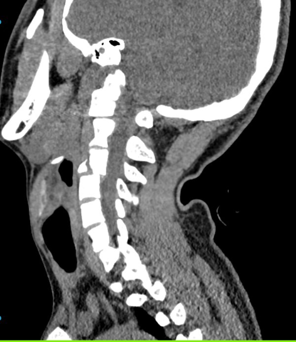 Anonymized sagittal cervical spine CT teaching image for suspected C3 fracture dislocation risk