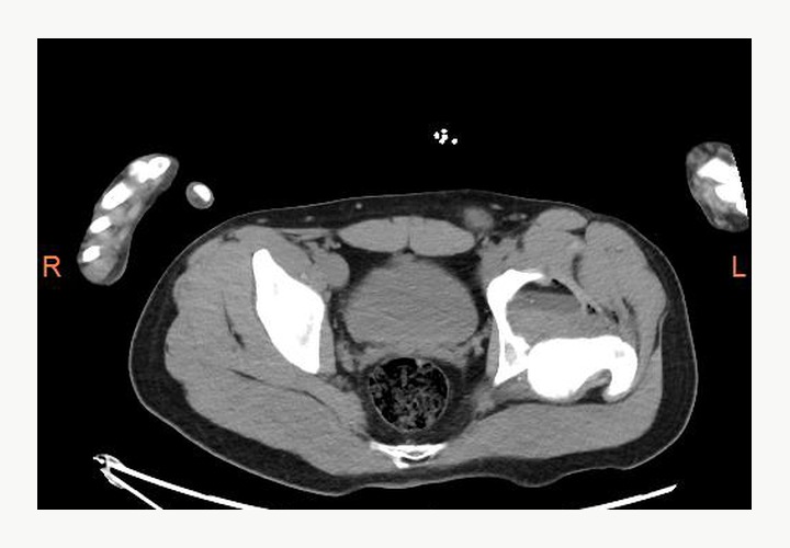 Anonymized axial pelvis and hip CT teaching image for left hip dislocation and acetabular injury concern