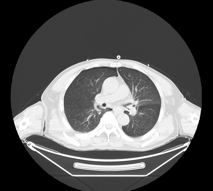 胸部轴位 CT 代表性教学图像