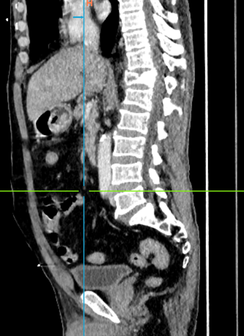 胸腰椎矢状位 CT 代表性教学图像