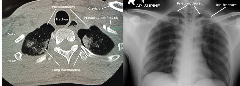 External case: post-traumatic pneumothorax and left first-rib fracture