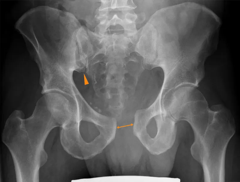 Open-book pelvic injury radiograph