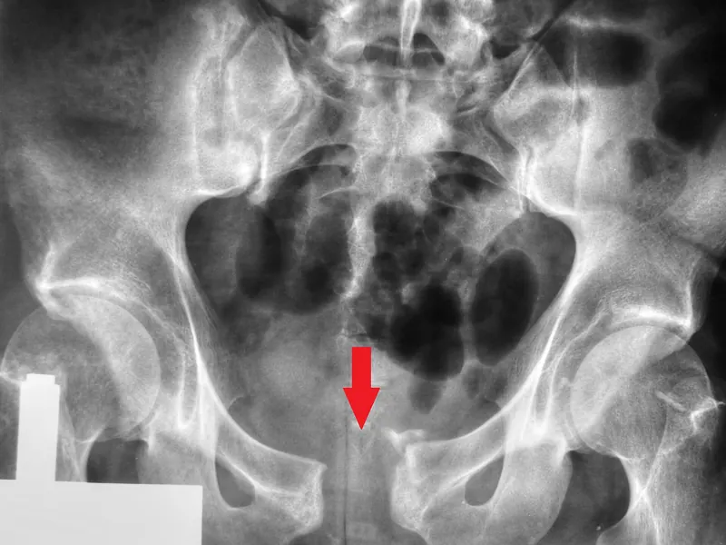 Symphysis pubis diastasis