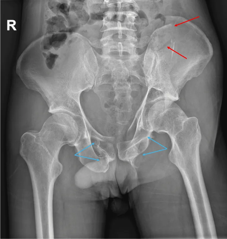 Leite-Moreira et al. 2026, Fig.1: complex pelvic ring injury