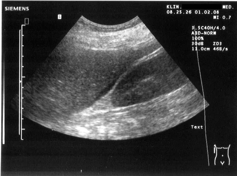 Authentic ultrasound: fluid in Morison’s pouch