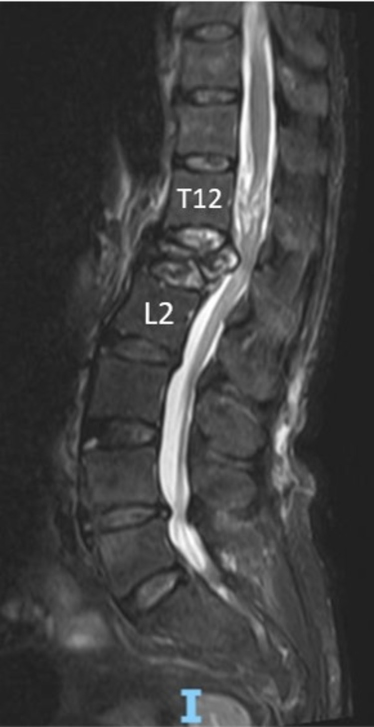 矢状位 MRI 示 L1 爆裂后突压迫马尾